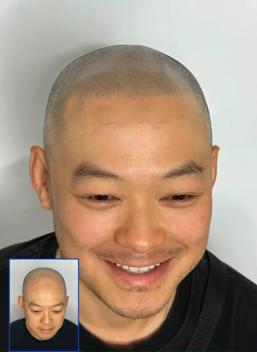  Scalp Micropigmentation