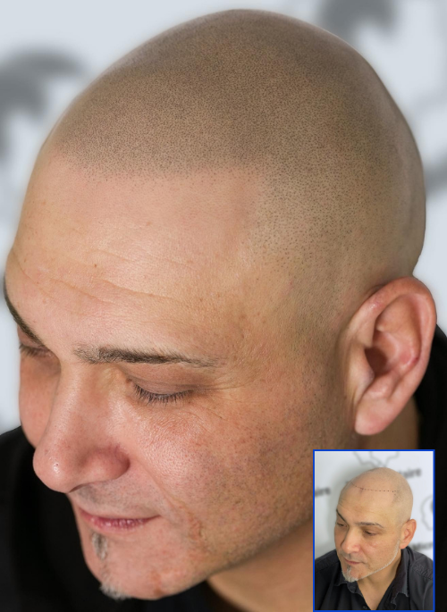  Scalp Micropigmentation