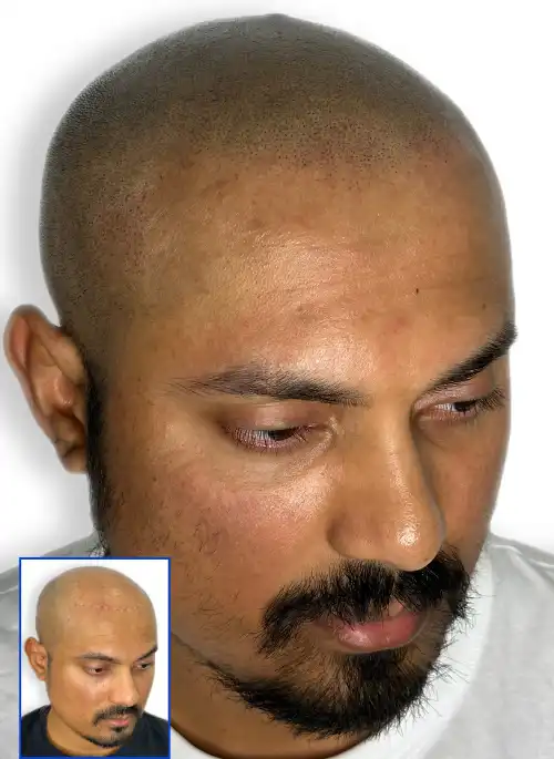  Scalp Micropigmentation