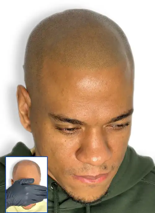  Scalp Micropigmentation