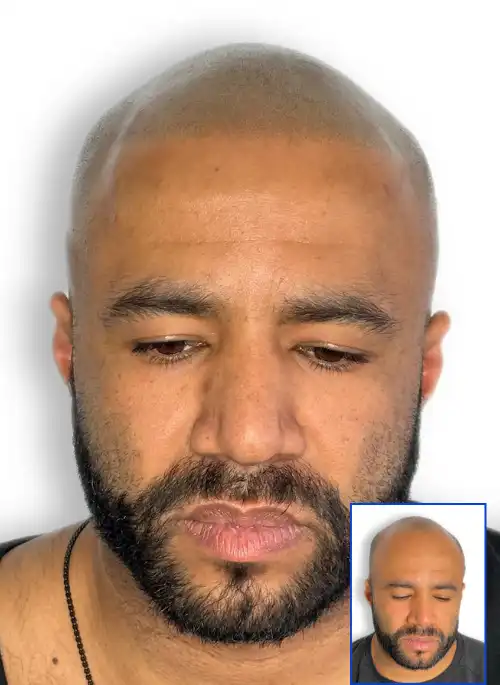  Scalp Micropigmentation