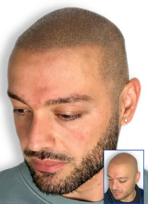  Scalp Micropigmentation