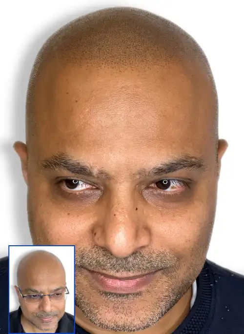  Scalp Micropigmentation