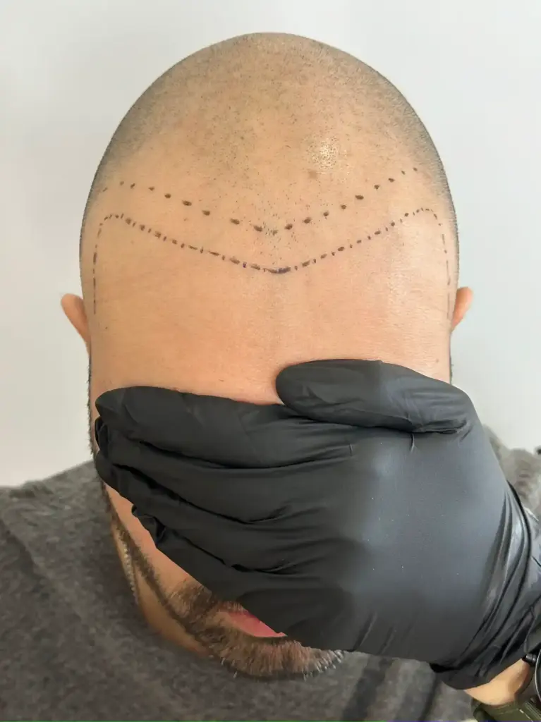 treatment candidates