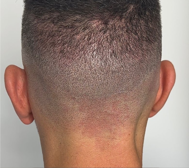 treatment candidates