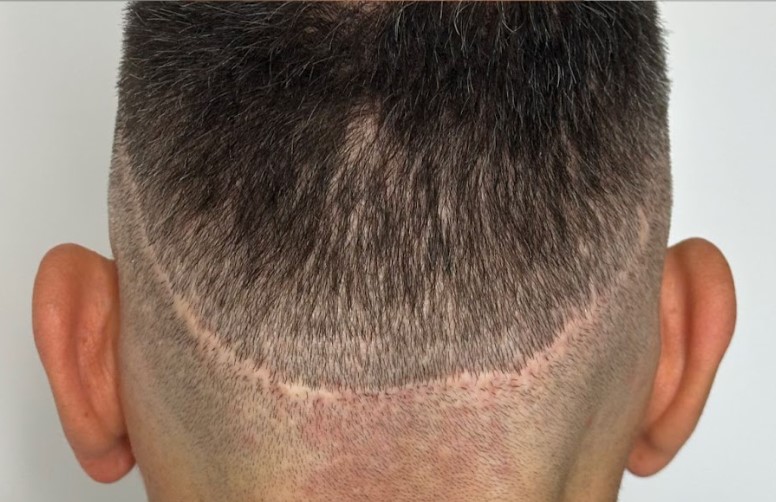 treatment candidates